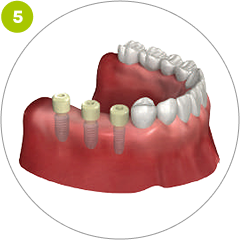 Step 5